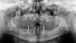 Mini-Implantate als Therapieoption für Senioren