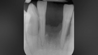 Sofortimplantation mit dem NNC-Implantat