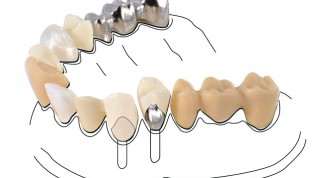Noninvasive Veneerversorgung im Frontzahnbereich