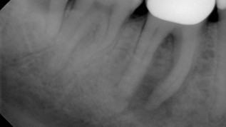 Therapieerfolg in der Endodontie mittels Laser