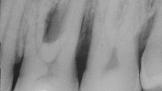 Parodontalbehandlung oder lieber Implantate?