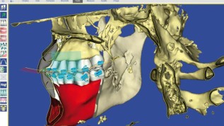 SureSmile® 7.0