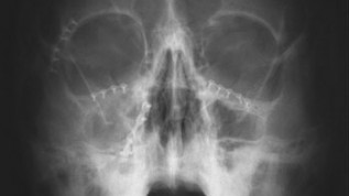 Implantatprothetische Reha nach Frontzahnverlust