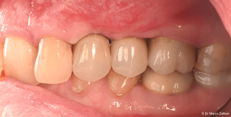 Fig. 14: Lateral view of the final prosthetic
restoration in place, demonstrating the
resulting occlusal relationship.