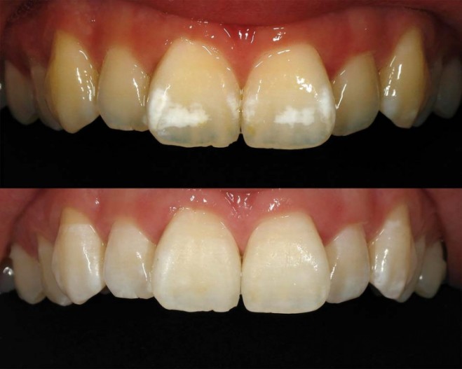 Fluoroseinfiltration Kasuistik Bei Einer Jungen Patientin Zwp Online Das Nachrichtenportal Fur Die Dentalbranche