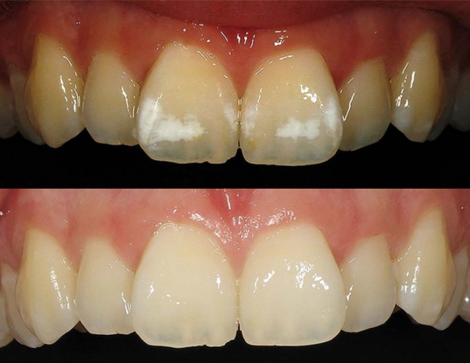 Fluoroseinfiltration Kasuistik Bei Einer Jungen Patientin Zwp Online Das Nachrichtenportal Fur Die Dentalbranche