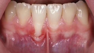 Schleimhauttransplantat zur Gingiva-Augmentation
