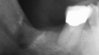 Minimalinvasive chirurgische Maßnahmen