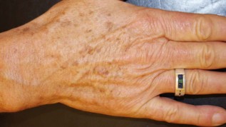 Die dermatologisch-ästhetische Lasertherapie