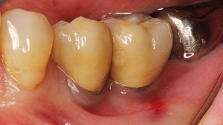 Periimplantitis – Eine Herausforderung