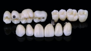 Zirkon – 100% biokompatibel und extra transluzent
