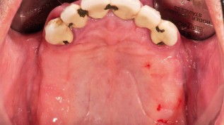 Implantatgetragene Verbundbrücke als Therapie