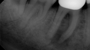 Laser als Erfolgsfaktor der Endo-Therapie?