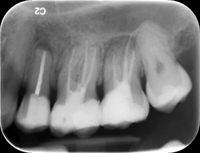 Zahnschmerzen Nach Wurzelfullung Beruhrungsschmerz