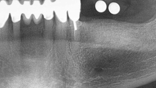 Besserung der mukogingivalen Situation durch Laser
