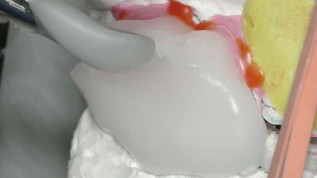 Apnoeschienen digital herstellen mittels CAD/CAM