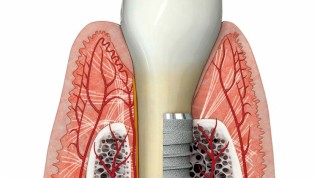 Einfluss des gingivalen Biotyps auf Implantate