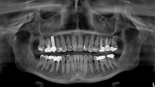 Piezochirurgie gestützte Explantation
