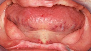 Implantatgetragener Zahnersatz auch mit 95 Jahren
