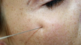 Filler-Behandlung: traumatisch oder atraumatisch?