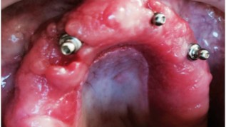 Lasertherapie von fibromatöser Prothesenstomatitis