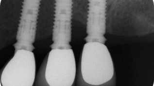 Periimplantitis – Das sollte man wissen