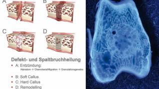 „Prevention for Extension“ in der Implantologie