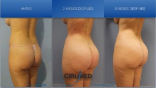 Wasserstrahlassistierte Lipokonturierung