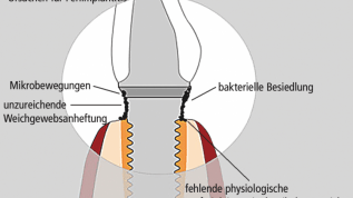 Behandlungstrategien periimplantärer Entzündungen