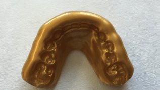 Goldener Mundschutz für Tim Wiese