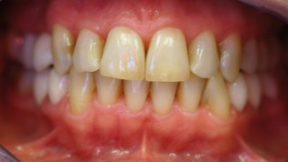 Frontzahnversorgung mit Presskeramikveneers