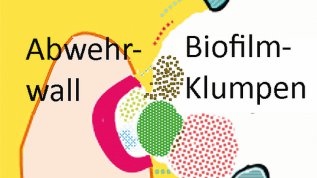 Bessere Überkappungen in tiefen Läsionen