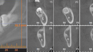 Knochentaschen bei Weisheitszahn-Osteotomien