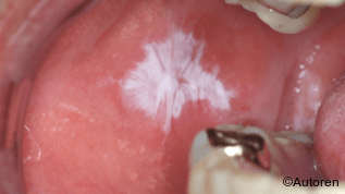 Therapie von oralen Leukoplakien