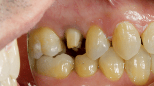 CEREC und Feldspatkeramik
