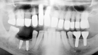 Abformung von Implantaten mit extremer Neigung