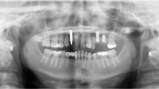 Keramikimplantat in ästhetischer Zone