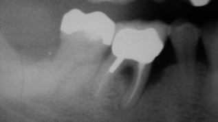 Alveoläre Knochenneubildung nach geschlossener PA