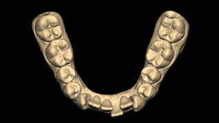 Hybrid-Aligner-Therapie