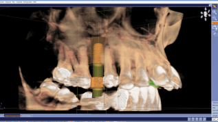 Guided Implant Surgery