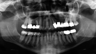 Zygoma-Implantat im Oberkiefer