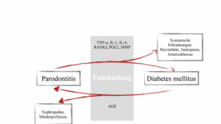Diabetes und Parodontitis eng verbunden