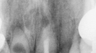 Erfolgreiche Endodontie in nur einer Sitzung!?