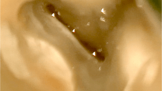 SAF-System – Teil 6: Mikroinvasive Behandlung