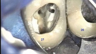 Endodontischer Erfolg durch Wissen um die Wurzelka