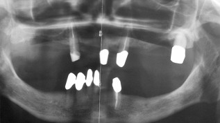 Verankerung von Zahnprothesen auf Implantaten