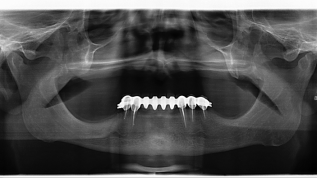 Zygoma Shorty All-on-4 nach totalem Knochenverlust