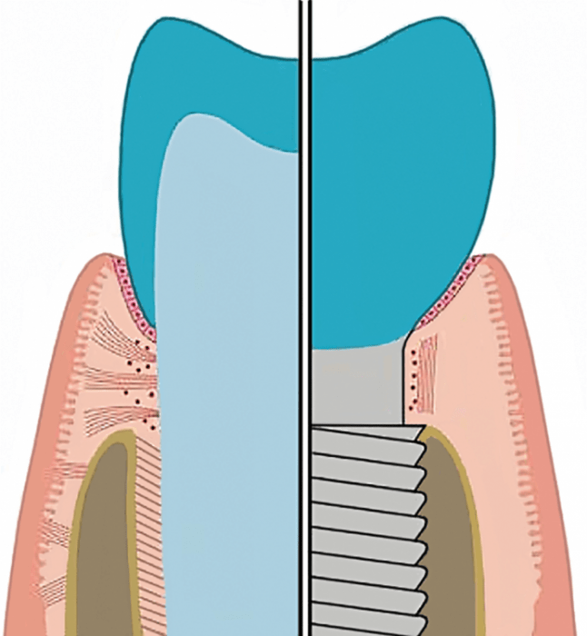 Periimplantäre Erkrankungen Teil 1 Erkennen ZWP online das
