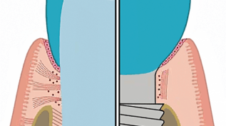 Periimplantäre Erkrankungen – Teil 1: Erkennen