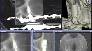 Diagnostik und Planung in der Implantologie